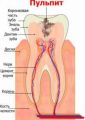 Лечение пульпита